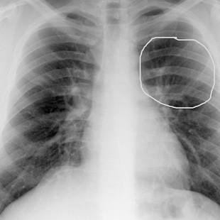 Câncer de pulmão é o de maior incidência no mundo, segundo OMS