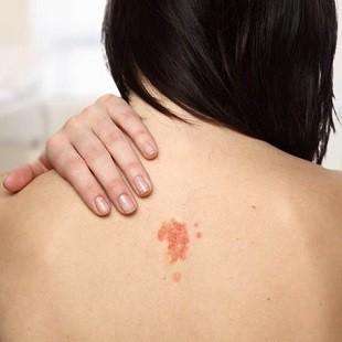 Tipos de câncer da pele