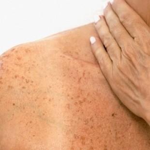 Sinais e Sintomas do Câncer de Pele