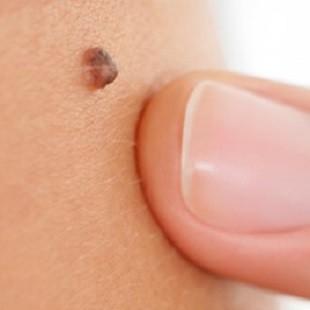 Pintas e sinais na pele